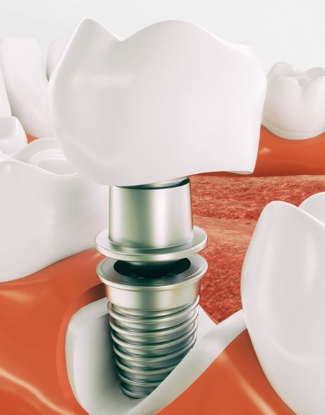 Dental Implants in Ermington