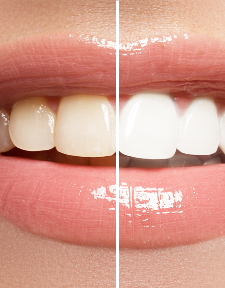 Teeth Whitening Newington Dentist