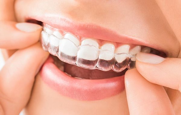 Invisalign Denistone