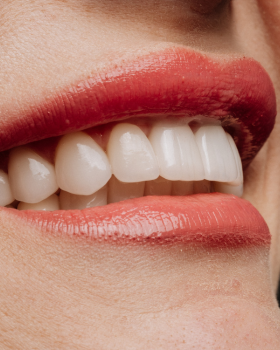 Teeth Whitening