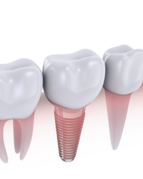 Dental Implants